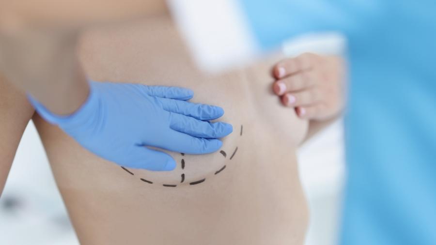 cirurgia de mama mamas seios implante silicone procedimento mamaria